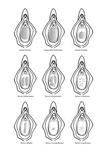 Vergin vagaina - Most people use the words “vagina” and “vulva” interchangeably, but there is a clear difference, and it’s about time more of us understood it. The vulva is the outer part of female sexual anatomy, made up of the labia majora, labia minora, clitoris, and vaginal opening. The vagina is the inner canal that connects the vulva to the cervix.